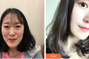 長春韓一美容醫(yī)院樸明旭整形價格表附眼部綜合案例展示