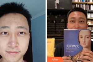 長春奧拉克美容醫(yī)院李京丘整形價格表附種眉毛案例展示