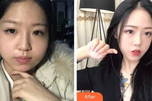 長春奧拉克美容醫(yī)院安淅鏞整形價格表附光子嫩膚案例展示