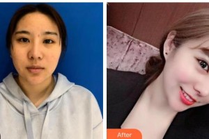 長春中妍醫(yī)療美容醫(yī)院陳永祥整形價格表附去痘印痘坑案例展示