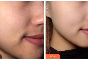 長春中妍醫(yī)療美容醫(yī)院曲芯慧住院醫(yī)師整形價格表附激光祛斑案例展示