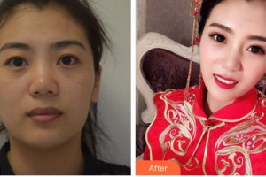 長春劉曉娟整形美容醫(yī)院劉曉娟整形價格表附埋線提升案例展示