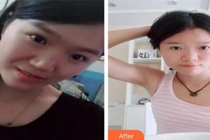 長春美奇醫(yī)療美容外科門診部張鵬飛整形價格表附埋線提升案例展示