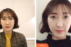 長(zhǎng)春瑞爾麗整形美容門(mén)診部姜宗和整形價(jià)格表附超聲提拉案例展示