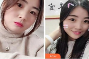 長(zhǎng)春奧拉克美容醫(yī)院侯克整形價(jià)格表附埋線提升案例展示