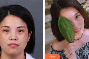 長春奧拉克美容醫(yī)院高微整形價格表附微針?biāo)獍咐故?>
</a>
<h3 class=