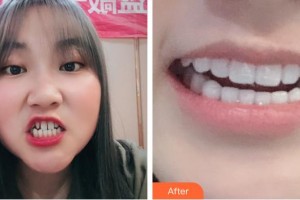 長(zhǎng)春欣雅口腔門(mén)診部樸月梅住院醫(yī)師整形價(jià)格表附牙貼面案例展示