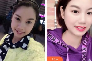 長(zhǎng)春白求恩口腔醫(yī)院孫凱整形價(jià)格表附金屬托槽矯正案例展示