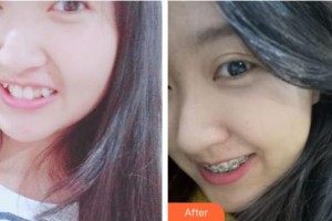 長(zhǎng)春環(huán)球口腔醫(yī)院路春宇整形價(jià)格表附金屬托槽矯正案例展示