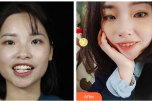 長(zhǎng)春白求恩口腔醫(yī)院楊溢整形價(jià)格表附金屬托槽矯正案例展示