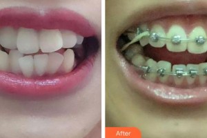 長(zhǎng)春詩(shī)邁爾口腔門(mén)診部宋邦嘯整形價(jià)格表附金屬托槽矯正案例展示