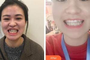 長(zhǎng)春詩(shī)邁爾口腔門(mén)診部朱峰整形價(jià)格表附牙齒隱形矯正案例展示