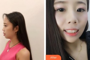 長春欣雅口腔門診部鄭雷整形價格表附牙齒隱形矯正案例展示