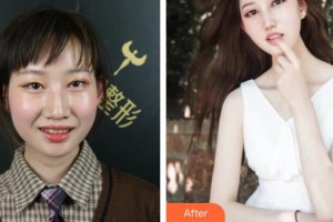 四平市燒傷整形醫(yī)院王國才整形價格表附牙齒隱形矯正案例展示