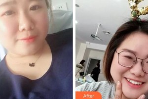 四平市燒傷整形醫(yī)院李笑豐整形價(jià)格表附牙齒隱形矯正案例展示