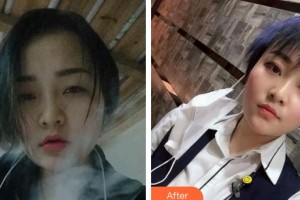 四平市燒傷整形醫(yī)院劉艷輝整形價(jià)格表附光子嫩膚案例展示