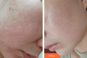 四平王清純醫(yī)療美容診所王秀純整形價(jià)格表附去痘印痘坑案例展示