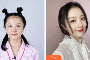 南昌佳美美容醫(yī)院粟東整形價(jià)格表附植發(fā)案例展示