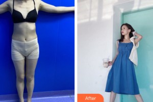 新疆千禧麗人整形美容醫(yī)院趙靖整形價(jià)格表附大腿吸脂案例展示