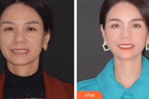 新疆威茲曼整形外科醫(yī)院宋建星整形價(jià)格表附牙齒矯正案例展示