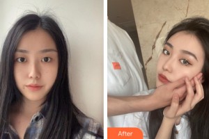 佳木斯中心醫(yī)院美容外科陳曦整形價(jià)格表附眼部手術(shù)案例展示