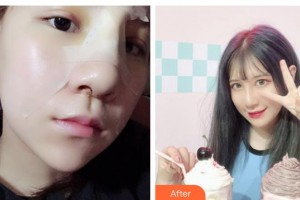 白山漢誠醫(yī)療美容門診部管齊花整形價格表附鼻部綜合案例展示