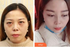 松原富華整形美容醫(yī)院岳洪忠整形價格表附鼻部綜合案例展示