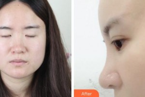 松原齊飛美容外科門診部杜彥超整形價格表附耳軟骨復(fù)合隆鼻案例展示