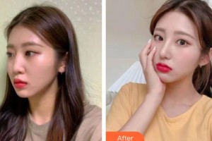 松原齊飛美容外科門診部周春玲整形價格表附鼻部綜合案例展示