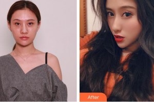 松原銘醫(yī)整形美容醫(yī)院徐曉宇整形價格表附硅膠隆鼻案例展示