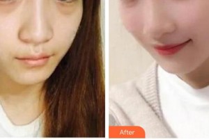 白城春俏美容整形醫(yī)院李海英住院醫(yī)師整形價格表附埋線提升案例展示