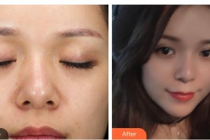 白城春俏美容整形醫(yī)院許鐵焰整形價格表附熱拉提案例展示