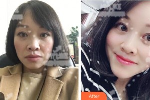 白城春俏美容整形醫(yī)院黃潔整形價格表附埋線提升案例展示