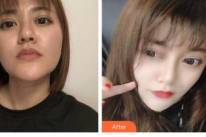 陜西華西醫(yī)院西美整形美容中心李明升整形價(jià)格表附埋線提升案例展示