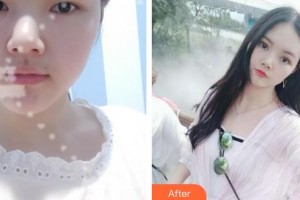 陜西省第二人民醫(yī)院眼科楊宇紅整形價(jià)格表附眼部綜合案例展示