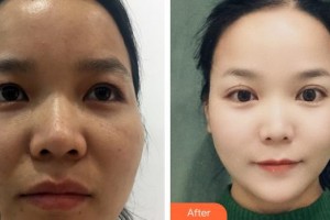 陜西省人民醫(yī)院燒傷整形醫(yī)學(xué)美容科張振信整形價(jià)格表附切開雙眼皮案例展示