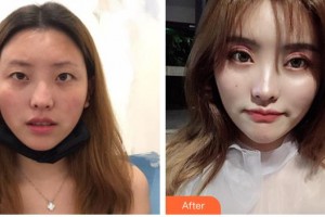 陜西省友誼醫(yī)院醫(yī)學(xué)整形科張潔整形價(jià)格表附定點(diǎn)雙眼皮案例展示