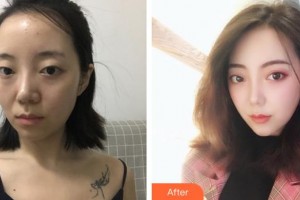 陜西電子409醫(yī)院整形外科張曄整形價(jià)格表附切開雙眼皮案例展示