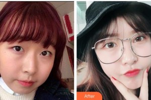 陜西省第二人民醫(yī)院眼科劉永平整形價(jià)格表附眼部綜合案例展示