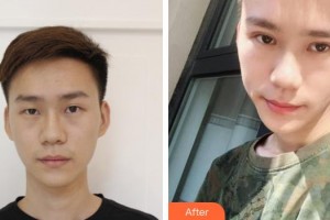 銅川礦務(wù)局中心醫(yī)院燒傷整形科王建軍整形價(jià)格表附切開雙眼皮案例展示