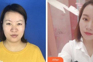 銅川礦務(wù)局中心醫(yī)院燒傷整形科諶煜整形價(jià)格表附切開雙眼皮案例展示