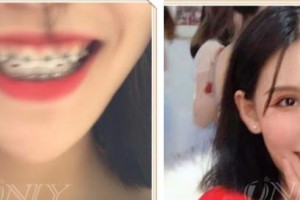 寶雞韓美醫(yī)療美容門診部連野杰整形價(jià)格表附金屬托槽矯正案例展示