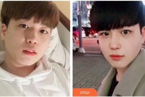 寶雞韓美醫(yī)療美容門診部林大植 整形價(jià)格表附去痘印痘坑案例展示