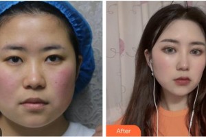 寶雞韓美醫(yī)療美容門診部李峰濤整形價(jià)格表附眼部綜合案例展示