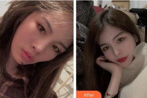 寶雞韓美醫(yī)療美容門診部張曉竹整形價(jià)格表附牙貼面案例展示