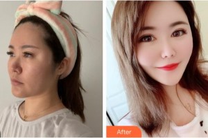 寶雞愛爾眼科醫(yī)院楚征宇整形價(jià)格表附牙齒陶瓷矯正案例展示