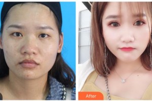 寶雞麗人婦科醫(yī)院醫(yī)療美容科竺湘云整形價(jià)格表附切開雙眼皮案例展示