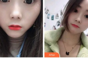 寶雞愛爾眼科醫(yī)院徐慶齋整形價(jià)格表附切開雙眼皮案例展示