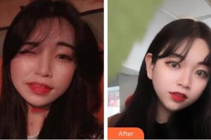 寶雞市口腔醫(yī)院景拴讓整形價(jià)格表附牙齒隱形矯正案例展示