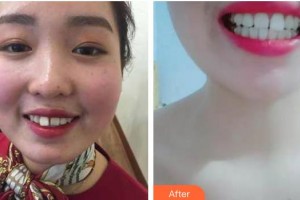 寶雞市口腔醫(yī)院朱萍芳整形價(jià)格表附牙齒隱形矯正案例展示